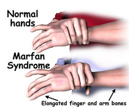 Characteristics & Symptoms - FIGHT FOR MARFAN SYNDROME!